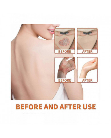 1/3/5pcs Psoriasises au venin d’abeille Crème Soulagement de la peau Crème anti-démangeaisons Produits de soins de [...]