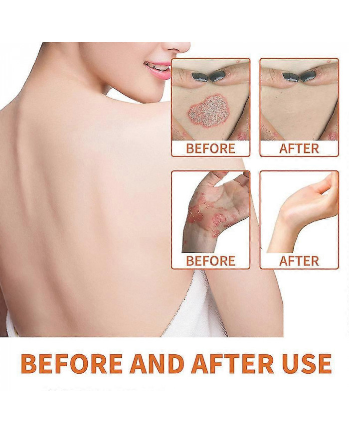 1/3/5pcs Psoriasises au venin d’abeille Crème Soulagement de la peau Crème anti-démangeaisons Produits de soins de [...]