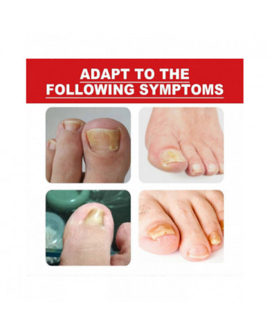 30ml Traitement des ongles incarnés,Traitement de la croissance des ongles,Gouttes d’ongles incarnés Huile pour [...]