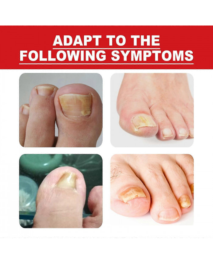 30ml Traitement des ongles incarnés,Traitement de la croissance des ongles,Gouttes d’ongles incarnés Huile pour [...]