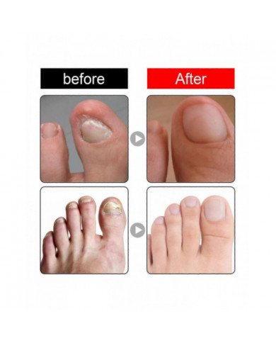 30ml Traitement des ongles incarnés,Traitement de la croissance des ongles,Gouttes d’ongles incarnés Huile pour [...]