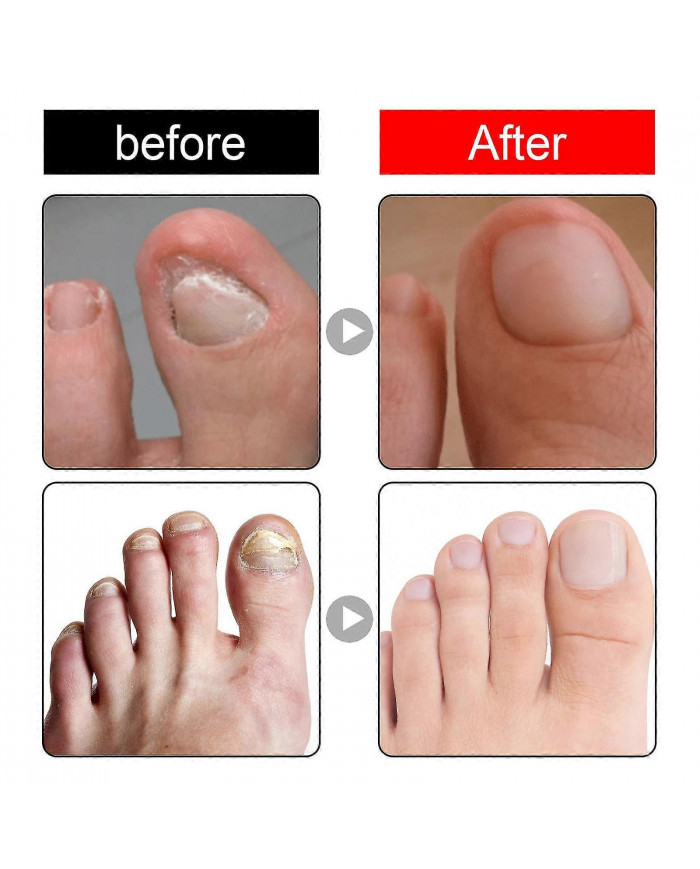 30ml Traitement des ongles incarnés,Traitement de la croissance des ongles,Gouttes d’ongles incarnés Huile pour [...]