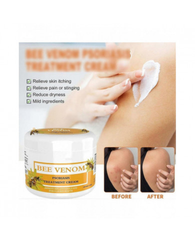 Crème pour psoriasis au venin d’abeille, Crème pour les traitements du psoriasis au venin d’abeille, Crème anti- [...]