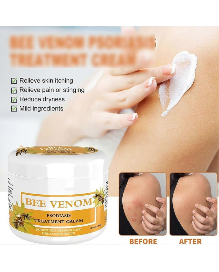Crème pour psoriasis au venin d’abeille, Crème pour les traitements du psoriasis au venin d’abeille, Crème anti- [...]