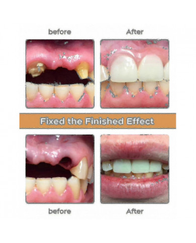 2024 Nwe Kit de prothèse dentaire, Le kit de bricolage de prothèse dentaire est simple et pratique Réparation de [...]