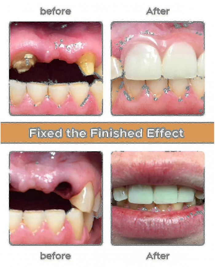 2024 Nwe Kit de prothèse dentaire, Le kit de bricolage de prothèse dentaire est simple et pratique Réparation de [...]