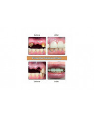 2024 Nwe Kit de prothèse dentaire, Le kit de bricolage de prothèse dentaire est simple et pratique Réparation de [...]