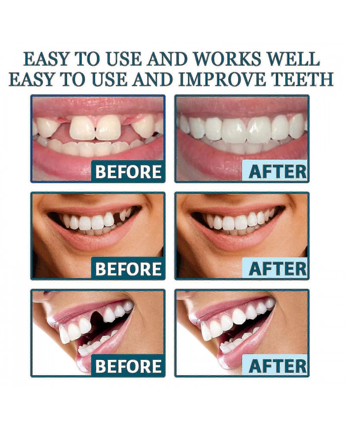 Prothèses dentaires encliquetables réglables, facettes Appareils orthodontiques pour prothèses dentaires Plus [...]