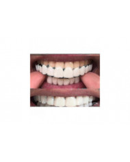 Accolades de prothèses dentaires de blanchiment Comfort Fit Flex supérieure/inférieure