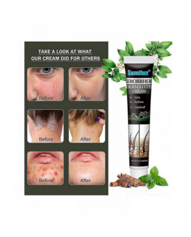 Traitement De La Dermatite Séborrhéique Psoriasique Crème Tête Acné Prurit Cuir Chevelu Teigne Réparation Crème [...]