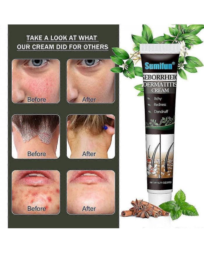 Traitement De La Dermatite Séborrhéique Psoriasique Crème Tête Acné Prurit Cuir Chevelu Teigne Réparation Crème [...]