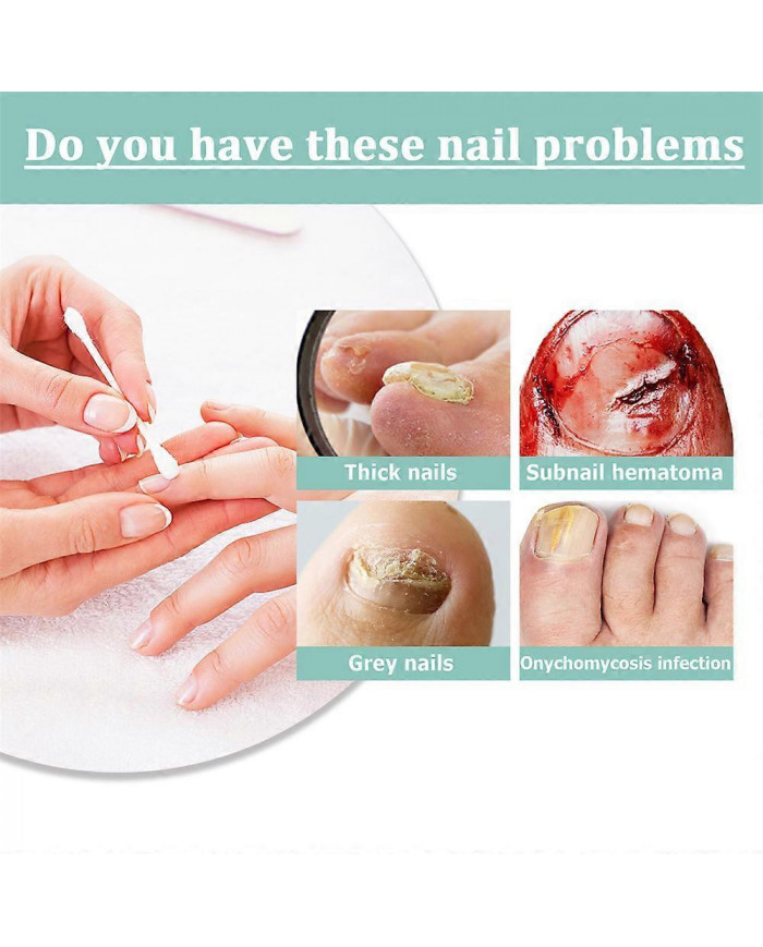 1/3/5 Pcs Stylo De Soins Des Ongles Stylo Ongle Champignon Traitement Ongle Infection Fongique