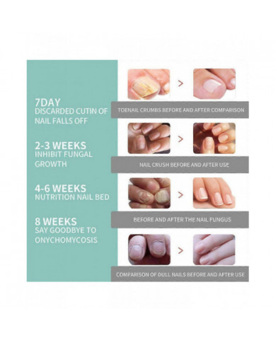 1/3/5 Pcs Stylo De Soins Des Ongles Stylo Ongle Champignon Traitement Ongle Infection Fongique