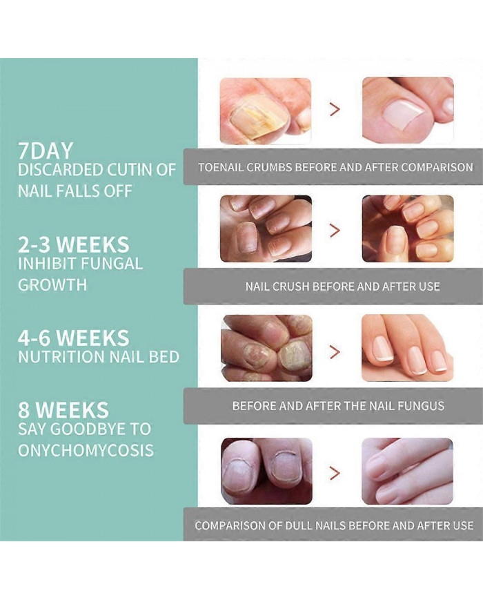 1/3/5 Pcs Stylo De Soins Des Ongles Stylo Ongle Champignon Traitement Ongle Infection Fongique