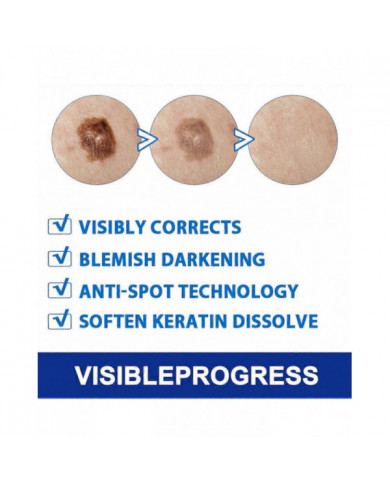 20g Verrues Onguents Nettoyants Anti-taches Chair Naevus Crème Décolorante pour Usage Externe