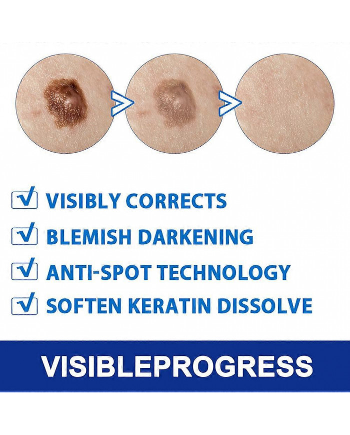 20g Verrues Onguents Nettoyants Anti-taches Chair Naevus Crème Décolorante pour Usage Externe