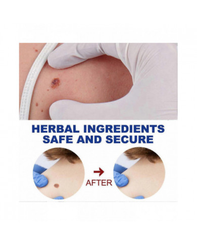 20g Verrues Onguents Nettoyants Anti-taches Chair Naevus Crème Décolorante pour Usage Externe