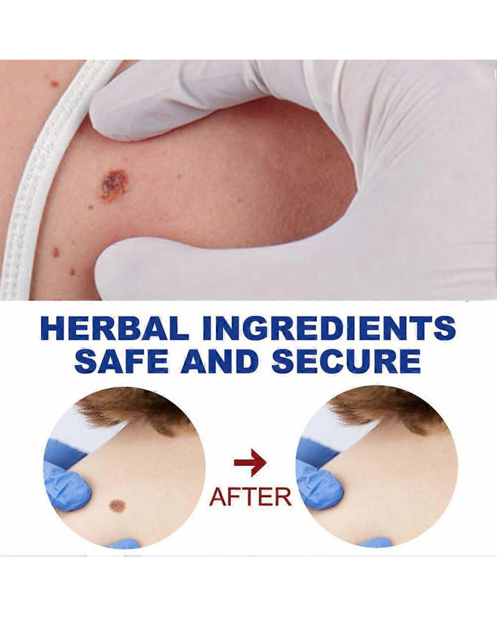 20g Verrues Onguents Nettoyants Anti-taches Chair Naevus Crème Décolorante pour Usage Externe