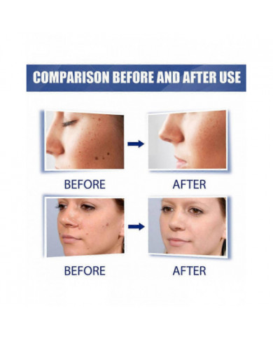 20g Verrues Onguents Nettoyants Anti-taches Chair Naevus Crème Décolorante pour Usage Externe