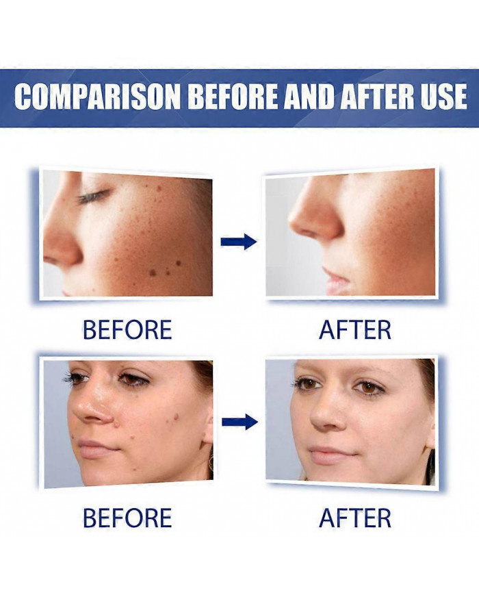 20g Verrues Onguents Nettoyants Anti-taches Chair Naevus Crème Décolorante pour Usage Externe