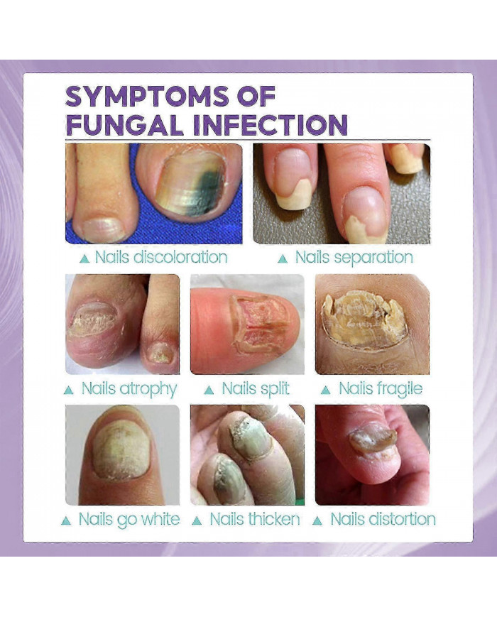 2pcs Medinail Fungus Spray Nouveau