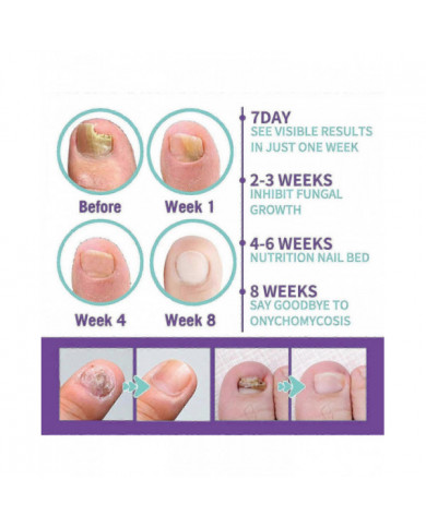 2pcs Medinail Fungus Spray Nouveau