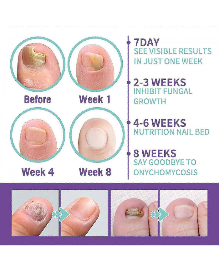 2pcs Medinail Fungus Spray Nouveau