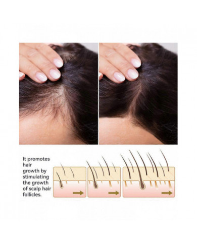 Spray pour la croissance des cheveux pour prévenir la perte de cheveux