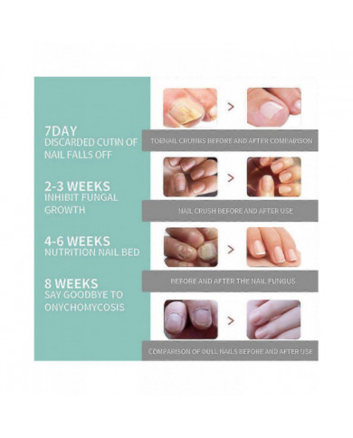 Stylo de traitement fongique des ongles pour les ongles des pieds et des mains, renforcement des ongles anti- [...]