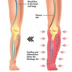 Apolloostory Drainage lymphatique Anneau magnétique thérapeutique