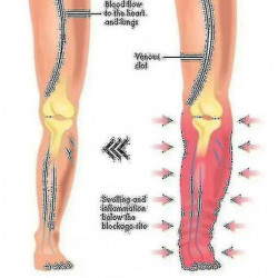 Apolloostory Drainage lymphatique Anneau magnétique thérapeutique