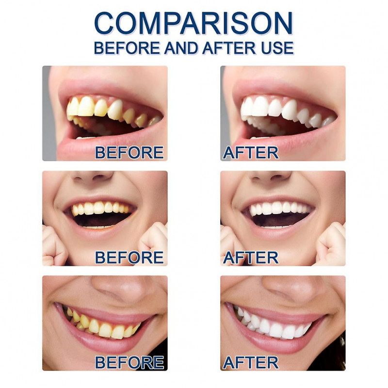 Blanchiment des dents Essence Nettoyage Élimine les taches de plaque Blanchiment des dents jaunes Hygiène buccale [...]
