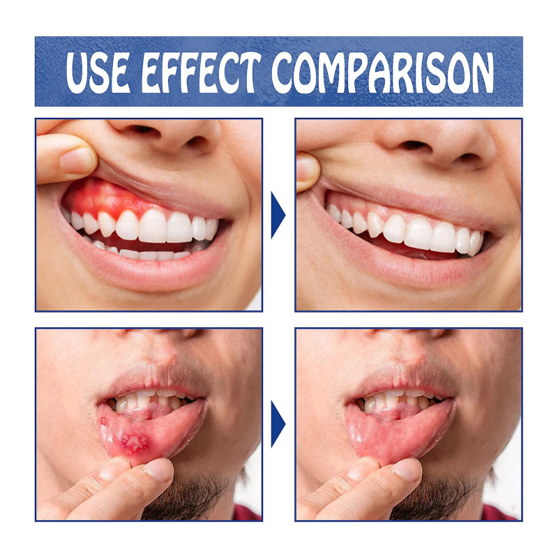 South Moon Oral Care Spray Relieve Swelling And Aching Of Gum Periodontal Foaming And Getting Angry Oral Care Spray