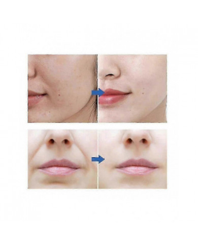 30pcs Microcristallin Sillons Nasogéniens Enlèvement Masque Visage Rides Enlèvement Masque Lift