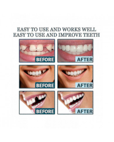 Dents de prothèse dentaire De fausses dents temporaires pour un sourire de confiance instantané, facettes [...]