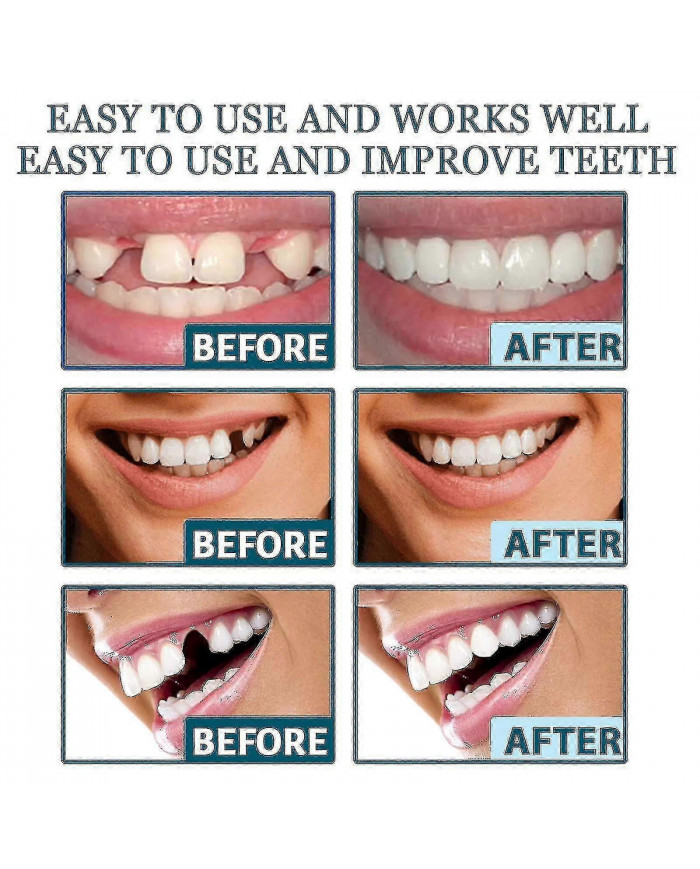 Dents de prothèse dentaire De fausses dents temporaires pour un sourire de confiance instantané, facettes [...]