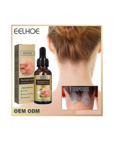 Huile essentielle de réparation du psoriasis - Soulagement de l’enflure anti-démangeaisons pour la main, le pied [...]