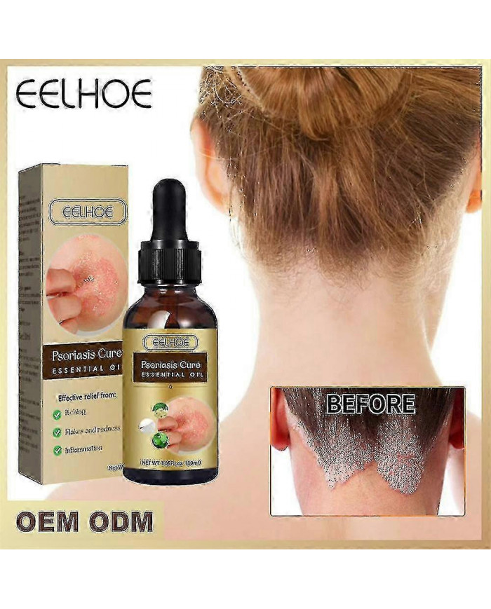 Huile essentielle de réparation du psoriasis - Soulagement de l’enflure anti-démangeaisons pour la main, le pied [...]