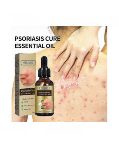 Huile essentielle de réparation du psoriasis - Soulagement de l’enflure anti-démangeaisons pour la main, le pied [...]