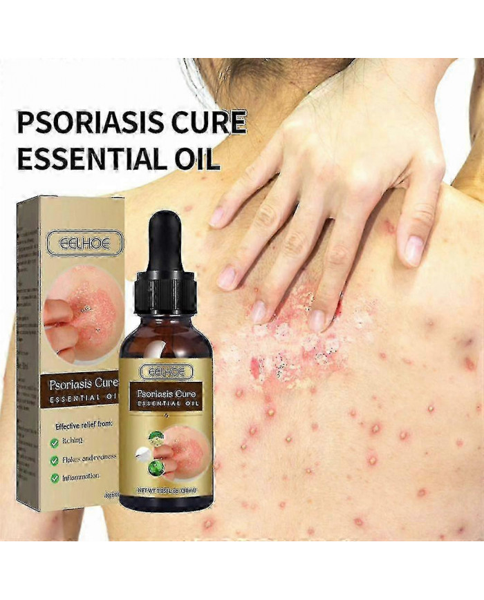 Huile essentielle de réparation du psoriasis - Soulagement de l’enflure anti-démangeaisons pour la main, le pied [...]