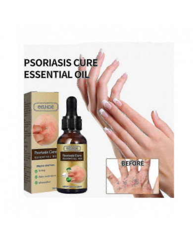 Huile essentielle de réparation du psoriasis - Soulagement de l’enflure anti-démangeaisons pour la main, le pied [...]