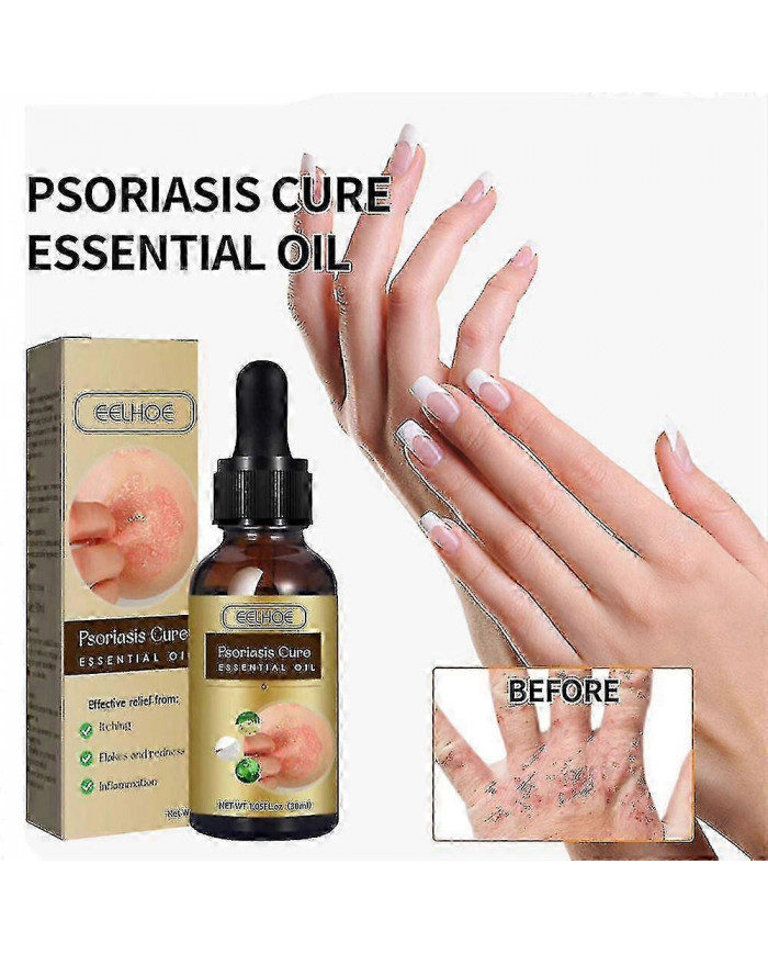 Huile essentielle de réparation du psoriasis - Soulagement de l’enflure anti-démangeaisons pour la main, le pied [...]