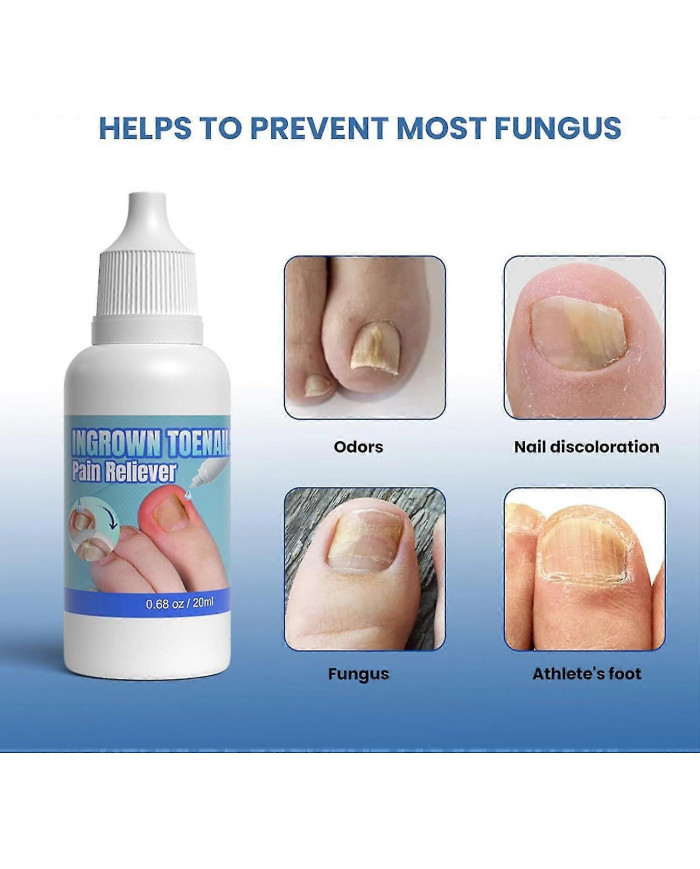 Traitement des ongles incarnés extra fort,Chute des ongles incarnés,Huile de soin des cuticules pour les ongles [...]