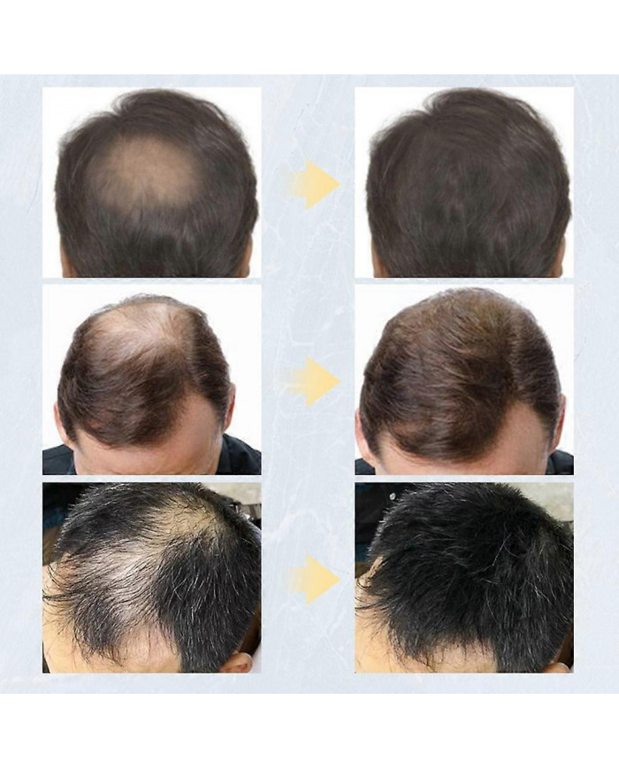 Kératine Fibres Capillaires Sujet Spray Applicateur 27.5g Poudre Colorée Pour La Perte De Cheveux Beauté Bâtiment [...]