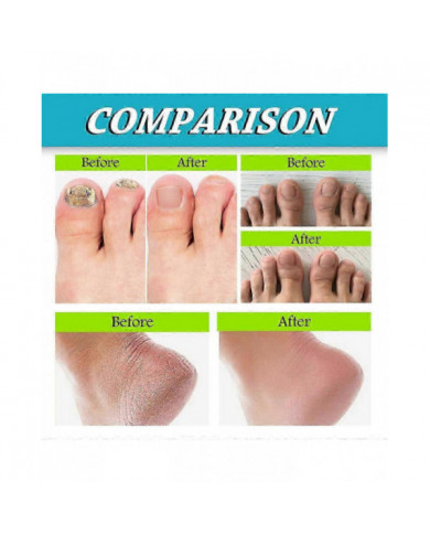 3pcs Foot And Nail Spary, Soins des pieds naturels et puissants