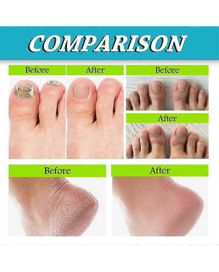 3pcs Foot And Nail Spary, Soins des pieds naturels et puissants