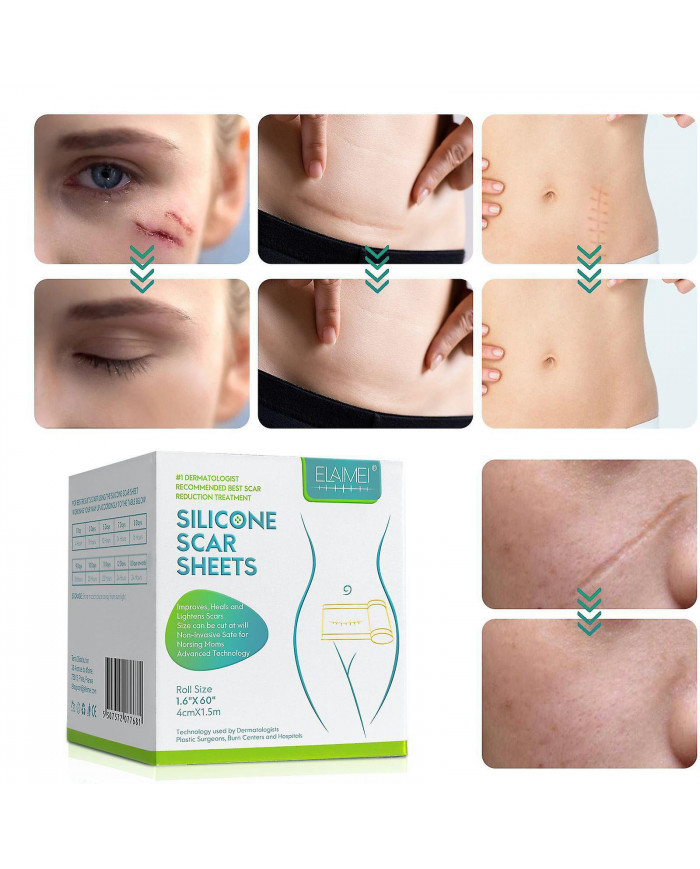 Huidverzorging Voor Het Gezicht Silicone Scar Patch, Silicone Scar Tape Roll, Silicone Scar Strip, Reusable Scar [...]