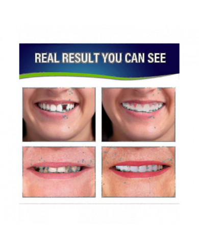 Ensemble de prothèses dentaires - Prothèses dentaires pour la mâchoire supérieure et inférieure pour un confort [...]