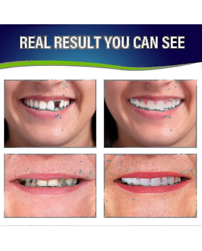 Ensemble de prothèses dentaires - Prothèses dentaires pour la mâchoire supérieure et inférieure pour un confort [...]