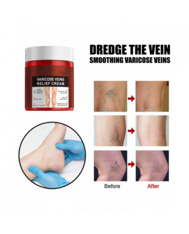 Crème anti-varices, Crème anti-variqueuse, Crème apaisante anti-variqueuse, Crème anti-varices pour les jambes, [...]